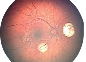 Cancer-associated retinopathy retinal biomarker scan