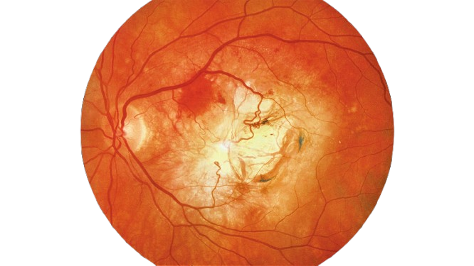 Cardiovascular disease retinal biomarker scan
