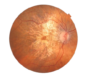 Macular degeneration retinal biomarker scan
